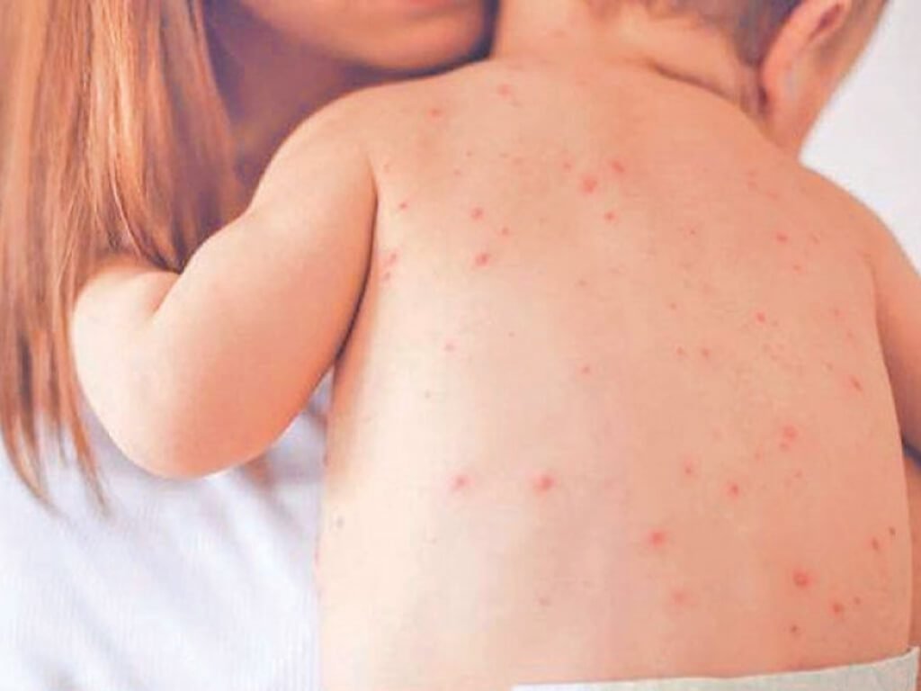 संयुक्त राज्य अमेरिकामा दादुराको प्रकोप, बालबालिका बढी प्रभावित